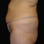 Before Abdominoplasty surgery Photos Case 11