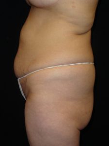 Before Abdominoplasty surgery Photos Case 11