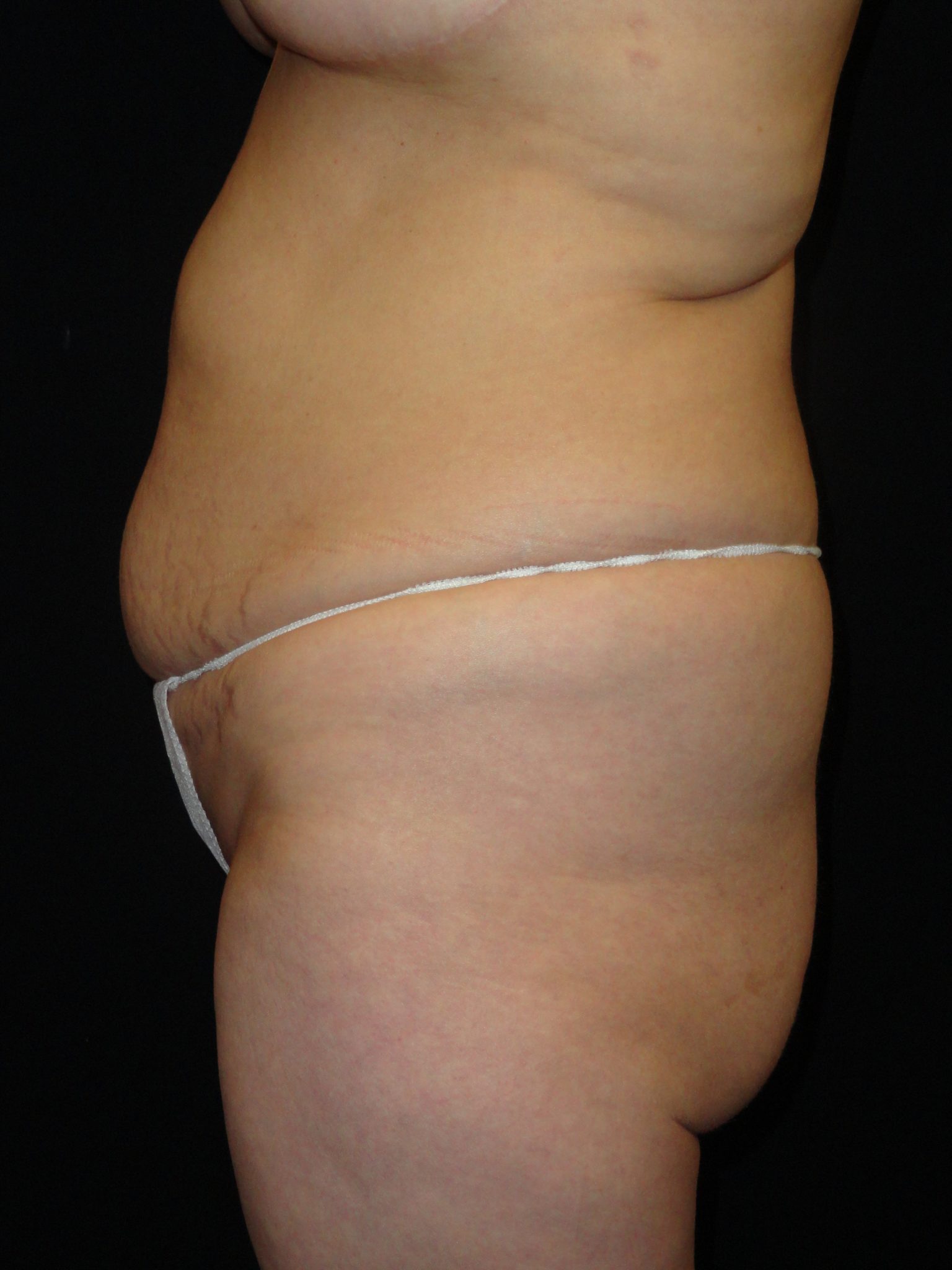 Before Abdominoplasty surgery Photos Case 11