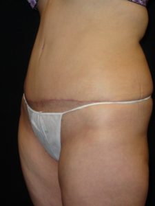 After Abdominoplasty surgery Photos Case 11