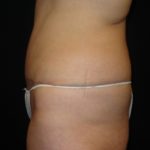 After Abdominoplasty surgery Photos Case 11