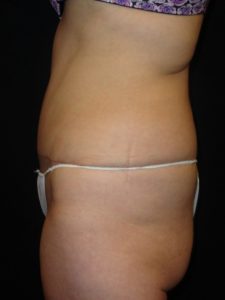 After Abdominoplasty surgery Photos Case 11