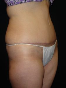 After Abdominoplasty surgery Photos Case 11