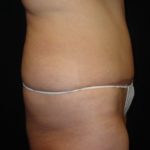 After Abdominoplasty surgery Photos Case 11