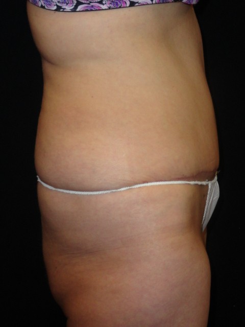After Abdominoplasty surgery Photos Case 11
