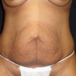 Phoenix Abdominoplasty Case 12 Before Photos