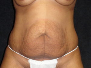 Phoenix Abdominoplasty Case 12 Before Photos