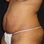 Phoenix Abdominoplasty Case 12 Before Photos