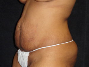 Phoenix Abdominoplasty Case 12 Before Photos