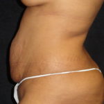 Phoenix Abdominoplasty Case 12 Before Photos