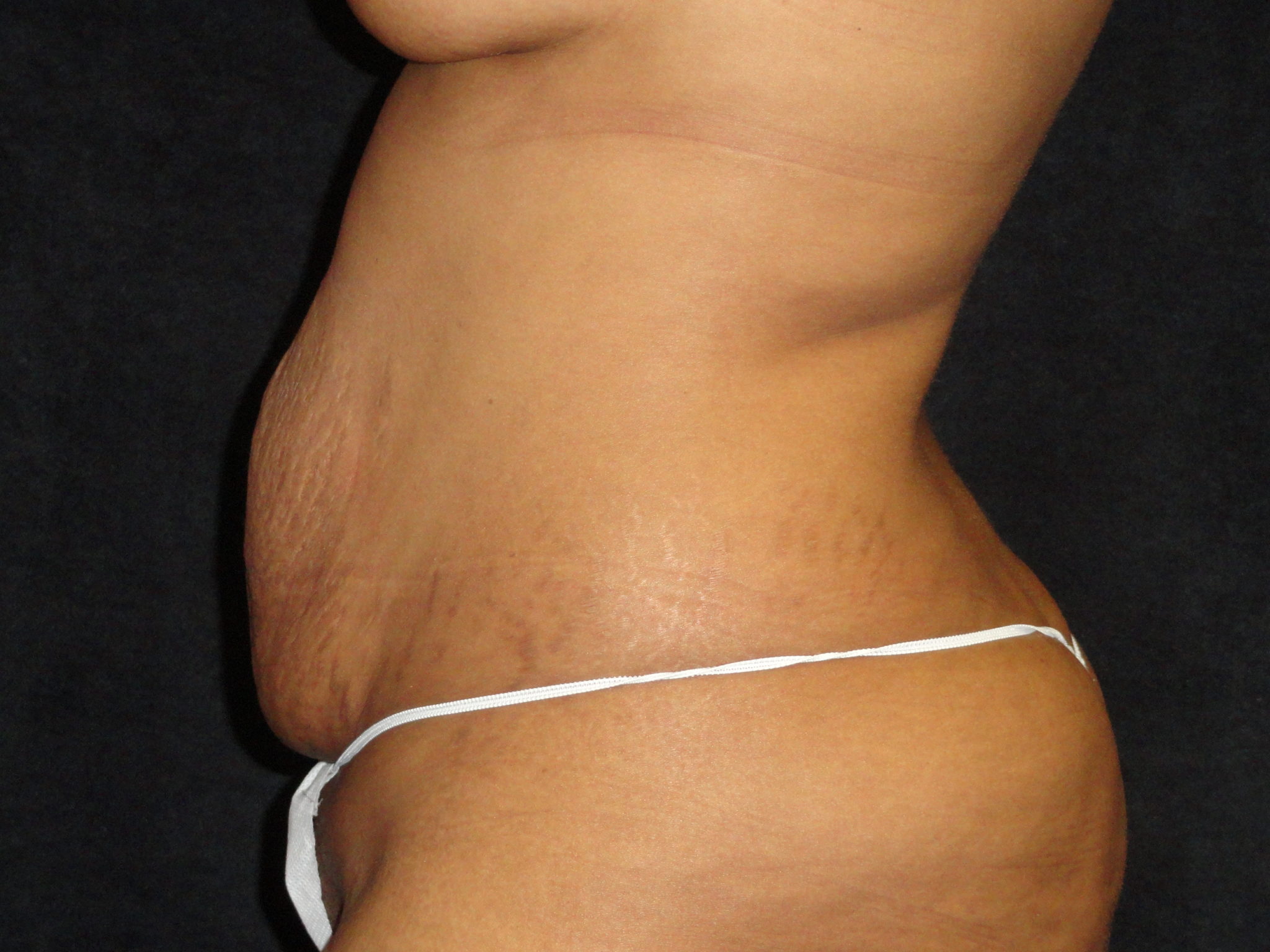 Phoenix Abdominoplasty Case 12 Before Photos