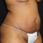 Phoenix Abdominoplasty Case 12 Before Photos