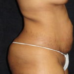 Phoenix Abdominoplasty Case 12 Before Photos