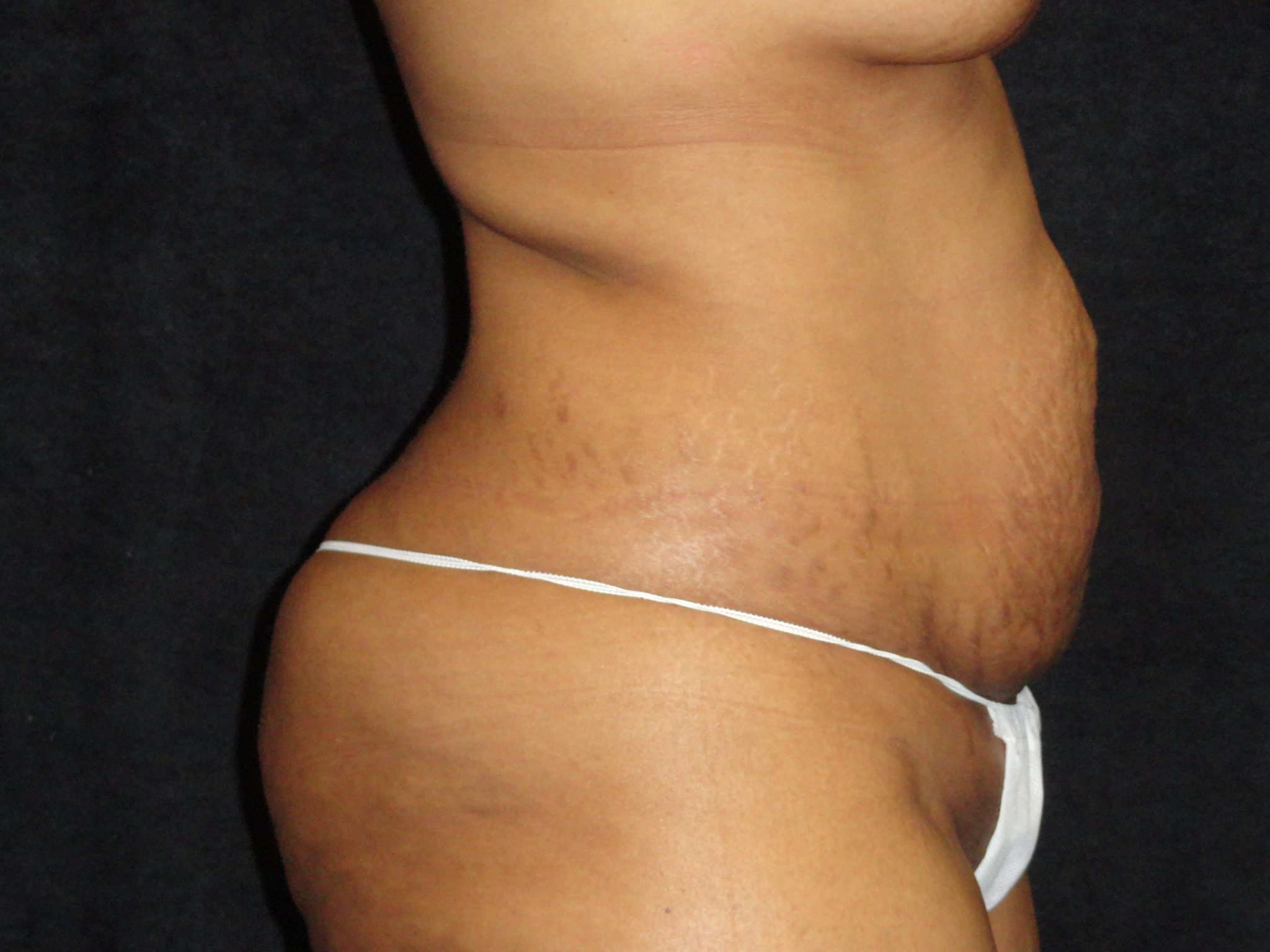 Phoenix Abdominoplasty Case 12 Before Photos