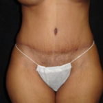 Phoenix Abdominoplasty Case 12 After Photos