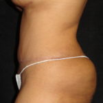 Phoenix Abdominoplasty Case 12 After Photos