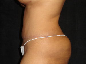 Phoenix Abdominoplasty Case 12 After Photos