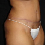 Phoenix Abdominoplasty Case 12 After Photos