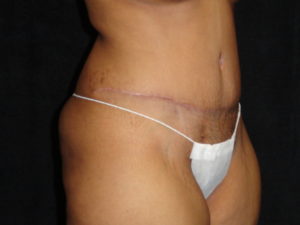 Phoenix Abdominoplasty Case 12 After Photos