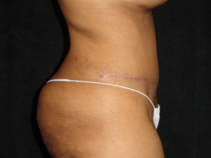 Phoenix Abdominoplasty Case 12 After Photos