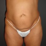 Abdominoplasty in Phoenix Arizona Before and After Photos