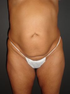 Abdominoplasty in Phoenix Arizona Before and After Photos