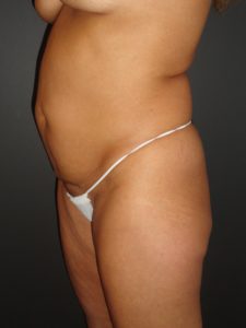 Abdominoplasty in Phoenix Arizona Before and After Photos