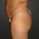 Abdominoplasty in Phoenix Arizona Before and After Photos