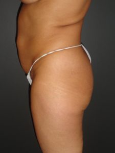 Abdominoplasty in Phoenix Arizona Before and After Photos