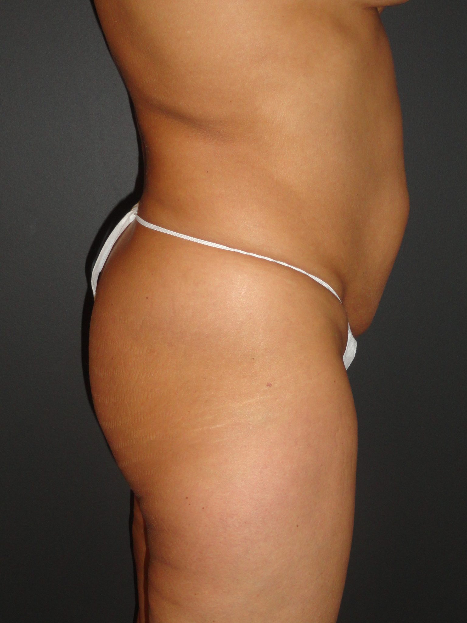 Abdominoplasty in Phoenix Arizona Before and After Photos