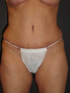 Abdominoplasty in Phoenix Arizona Before and After Photos