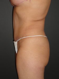 Abdominoplasty in Phoenix Arizona Before and After Photos