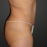 Abdominoplasty in Phoenix Arizona Before and After Photos