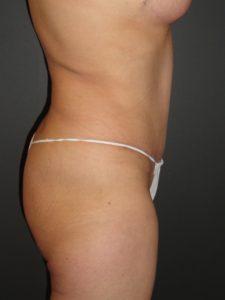 Abdominoplasty in Phoenix Arizona Before and After Photos