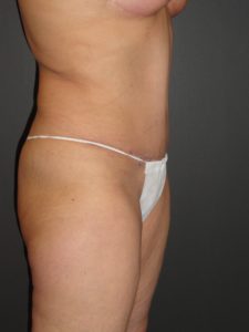 Abdominoplasty in Phoenix Arizona Before and After Photos