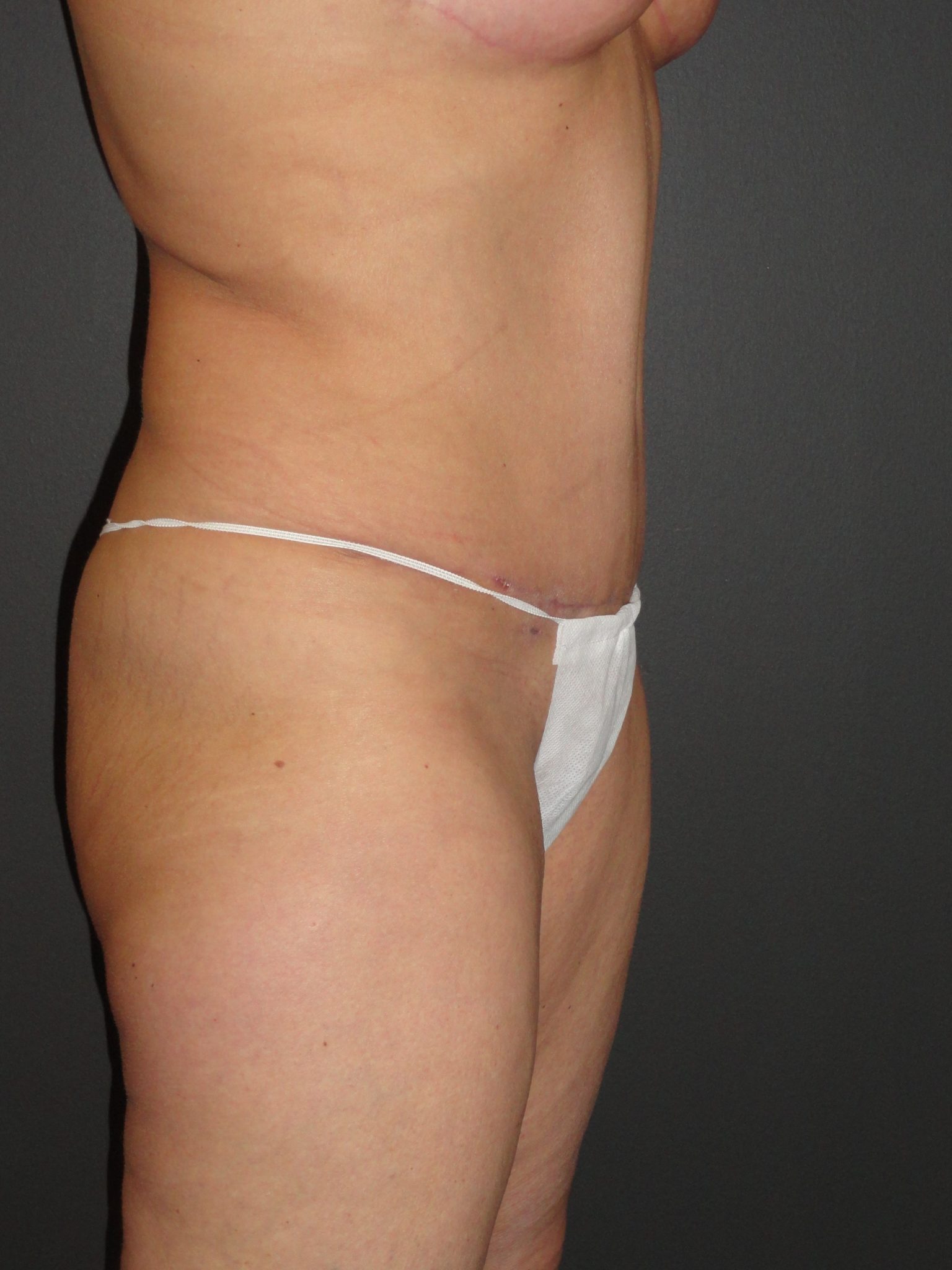 Abdominoplasty in Phoenix Arizona Before and After Photos