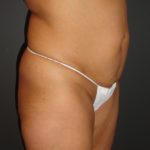 Abdominoplasty in Phoenix Arizona Before and After Photos