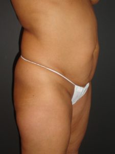 Abdominoplasty in Phoenix Arizona Before and After Photos