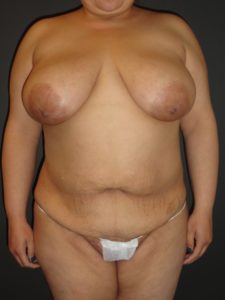 Mommy Makeover Before and After Photos with a Tummy Tuck and Breast Reduction