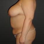 Mommy Makeover Before and After Photos with a Tummy Tuck and Breast Reduction