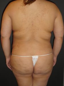 Mommy Makeover Before and After Photos with a Tummy Tuck and Breast Reduction