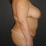 Mommy Makeover Before and After Photos with a Tummy Tuck and Breast Reduction