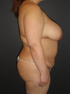 Mommy Makeover Before and After Photos with a Tummy Tuck and Breast Reduction