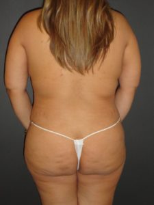 Mommy Makeover Before and After Photos with a Tummy Tuck and Breast Reduction