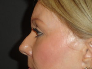 Blepharoplasty Arizona After Photos Case 5