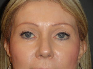 Blepharoplasty Arizona After Photos Case 5