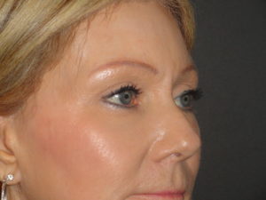 Blepharoplasty Arizona After Photos Case 5