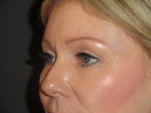 Blepharoplasty Arizona After Photos Case 5