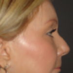 Blepharoplasty Arizona After Photos Case 5