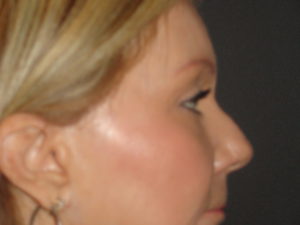 Blepharoplasty Arizona After Photos Case 5